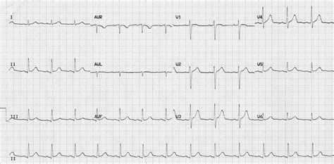 normal ecg sample|Iba pa.